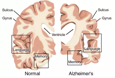 AD药物研发现状：辉瑞、礼来、百健、诺华、强生……