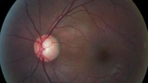 青光眼的克星来袭，助力患者远离视力的“窃贼”