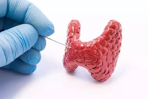 甲状腺疾。鬃聪俟δ芗跬撕图鬃聪俟δ芸航，自古以来就是反复被医学研究人员研究的疾病