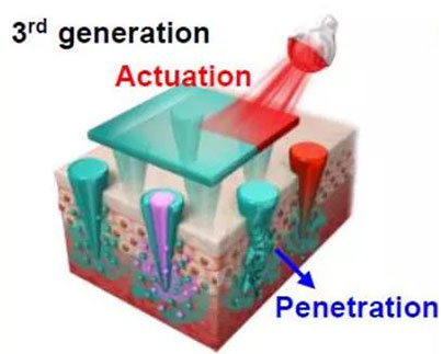 第三代：通过微针介导的皮肤层破坏和微针伴随的各种功能增强药物转运.jpg