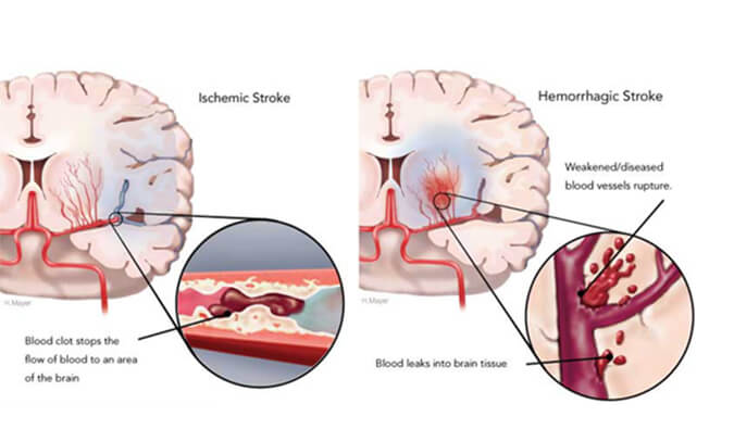世界卒中日：从动物药效模型评价看心脑血管药物开发